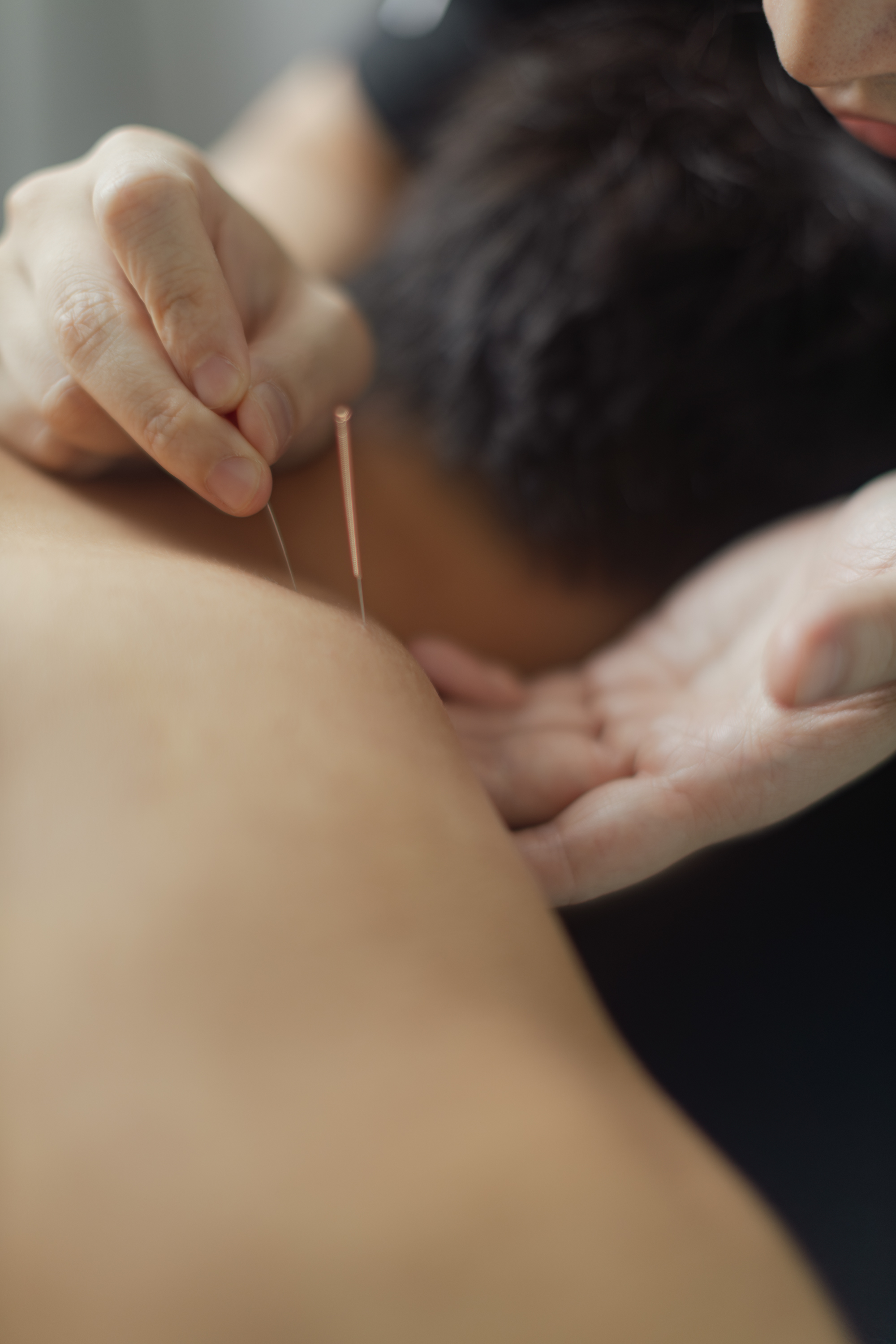 Dry Needling & Acupuncture